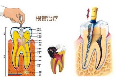 南京牙根管治疗的价格