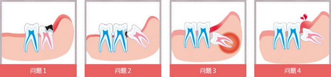 智齿导致牙龈肿痛怎么办？