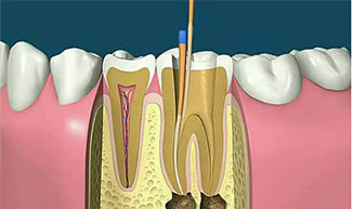 根管治疗