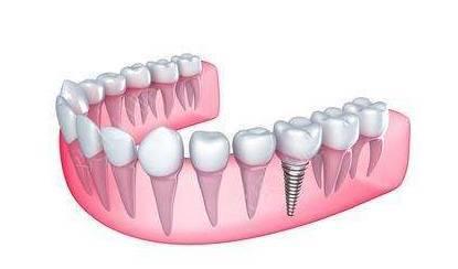 种植牙一般价格