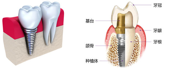 换牙多少钱一颗？