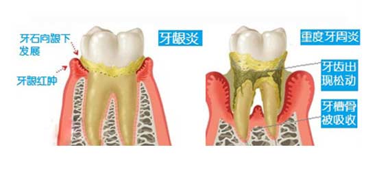 牙龈炎和牙周炎是一样的吗