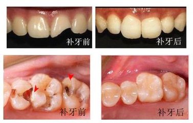 南京补牙后牙疼怎么办