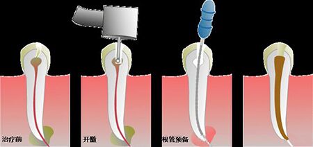 为什么根管治疗后还会牙痛